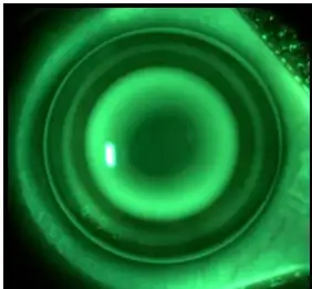 Les lentilles de nuit d'orthokratologie : Ksako ? Tout savoir sur ces lentilles rvolutionnaires grce  votre opticien  Cannes