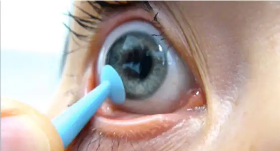 Les lentilles rigides pour myopie, astigmatisme, hypermtropie, presbytie et kratocne chez Californie optique  Cannes dans les Alpes Maritimes